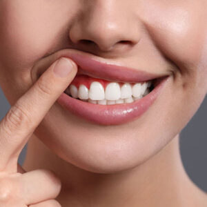 Example of inflamed gums