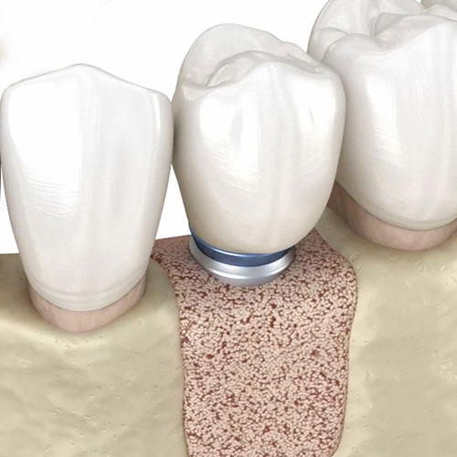 graphic of bone grafting with a dental implant