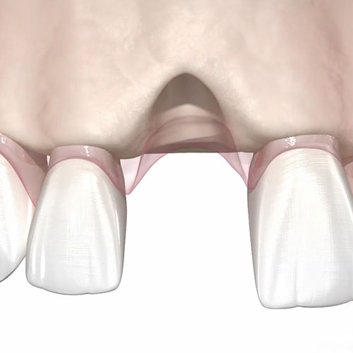 graphic of bone loss from a missing tooth