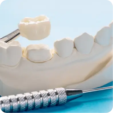 Image of crown being placed on a tooth model